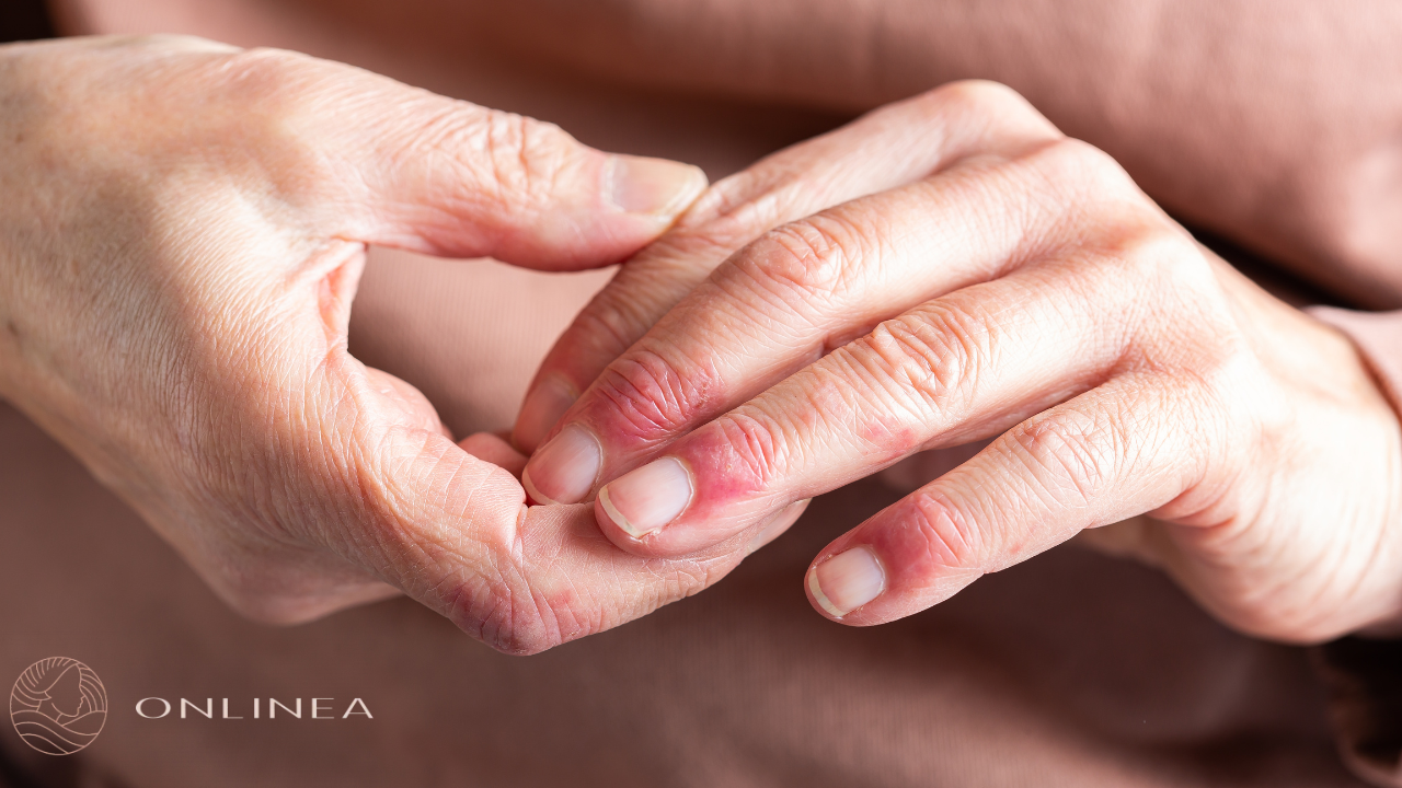 Atopijski dermatitis: simptomi, leenje i kreme | Apoteka Onlinea