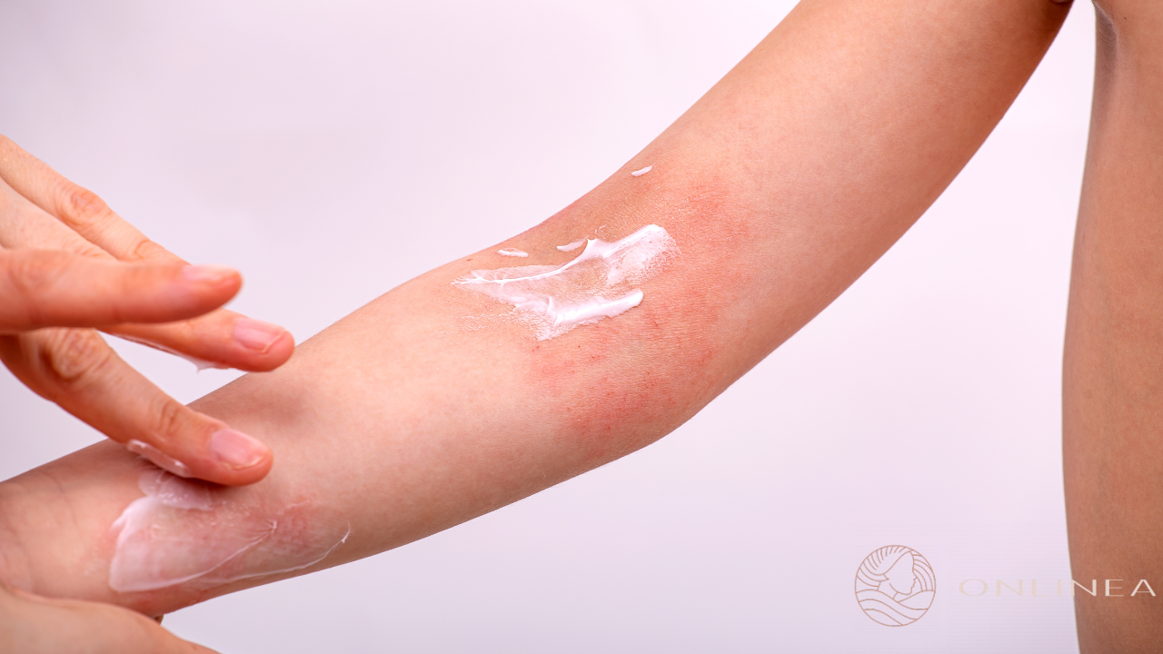 Atopijski dermatitis: simptomi, leenje i kreme | Apoteka Onlinea