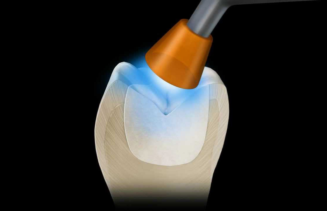 Lampa de Fotopolimerizare Tehnologii Implicate