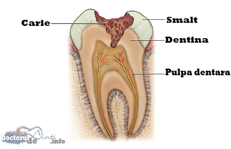 Primele semne ale cariei dentare