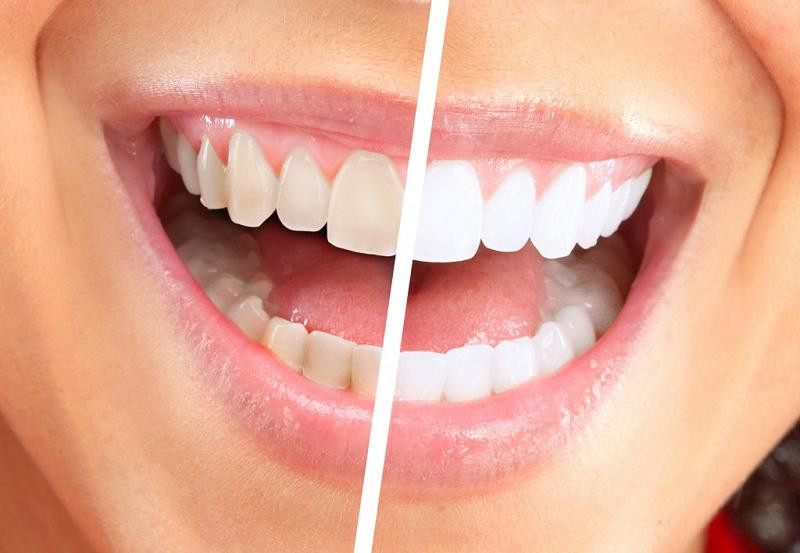Cum prevenim ingalbenirea dintilor ?