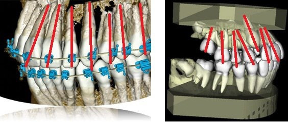 Aparatele dentare – răspunsuri de la A la Z