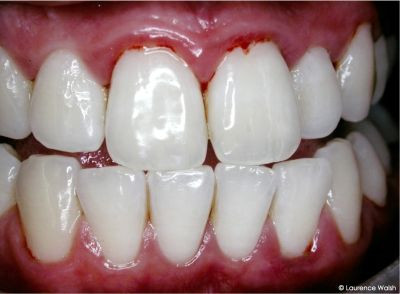 De ce îmi sângerează gingiile şi ce trebuie să fac