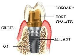 Implantul dentar