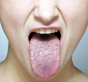 Xerostomia sau senzatia de gura uscata