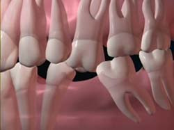 După extracţia dentară ; sfaturi