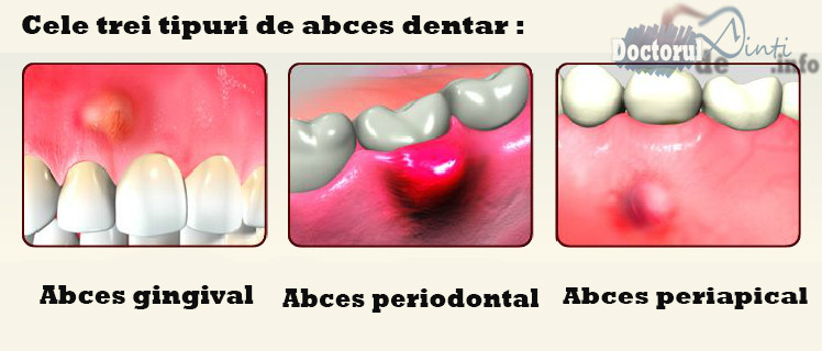 Abcesul dentar