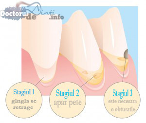 Tratamentul cariei dentare