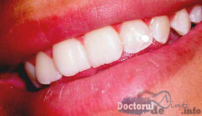 Bijuteriile dentare