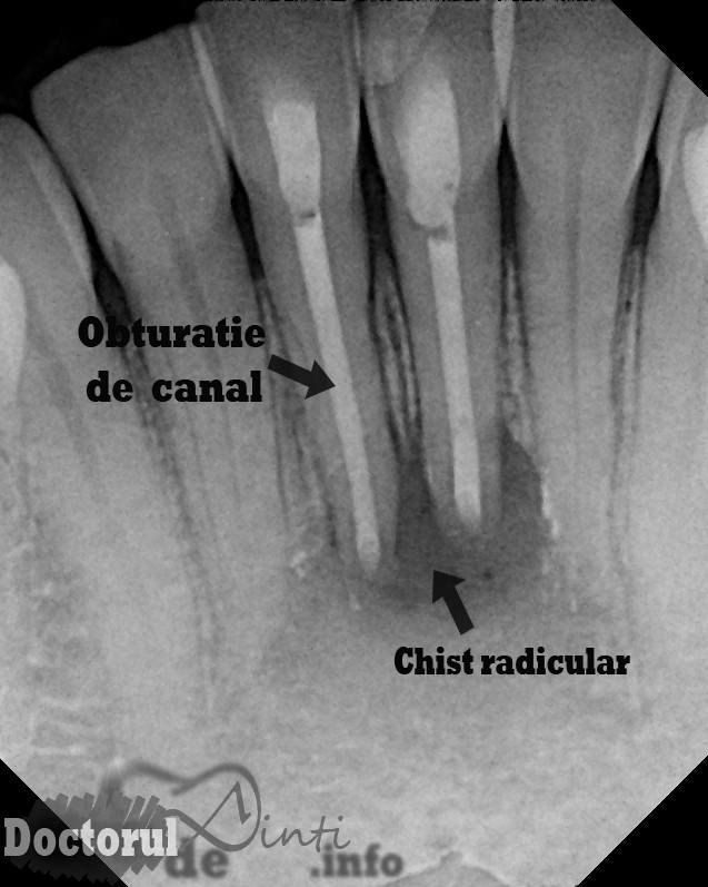Chistul dentar (radicular)