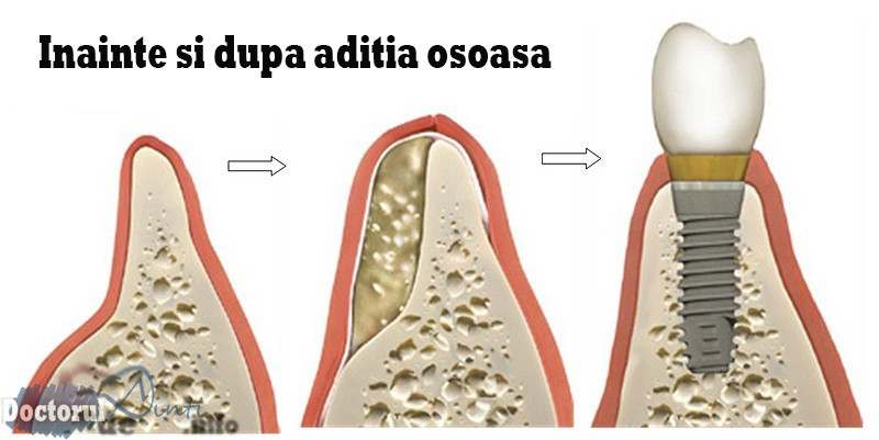 Aditia osoasa