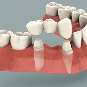 Puntea dentara