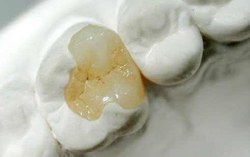 Ceramica vs compozit