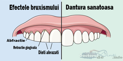 Tratament bruxism