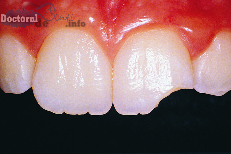 Traumatismele dentare