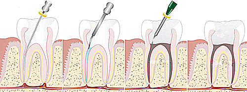Tratamentul de canal endodontic