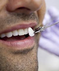Care sunt indicatiile si contraindicatiile fatetelor dentare