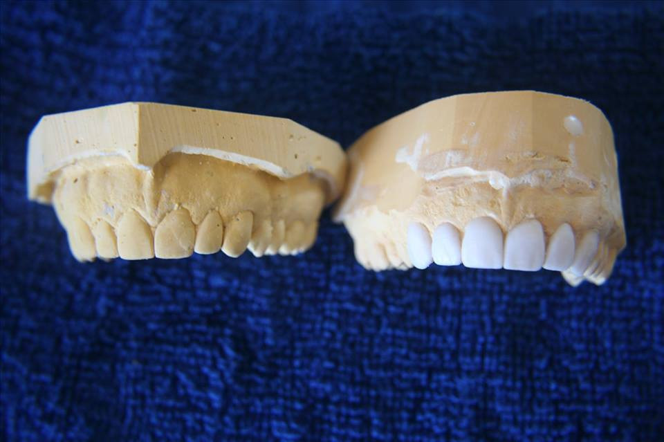 Wax-up-ul diagnostic