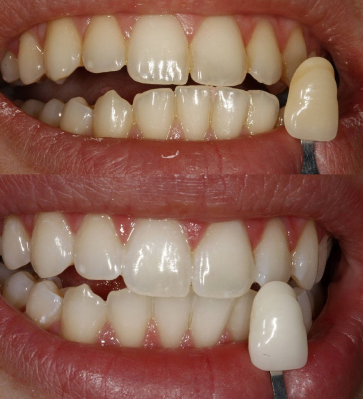 Riscuri albire dentara