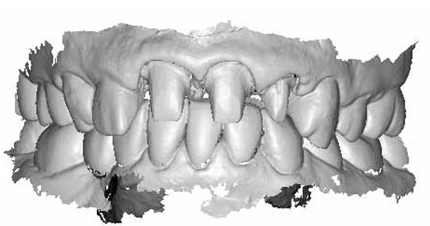 Amprenta dentara digitala