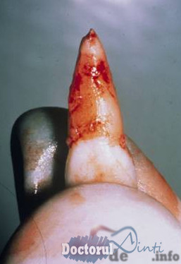 Primul ajutor pentru urgentele dentare ale copiilor