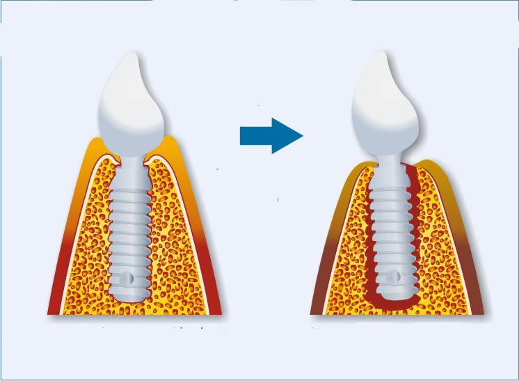 Periimplantita