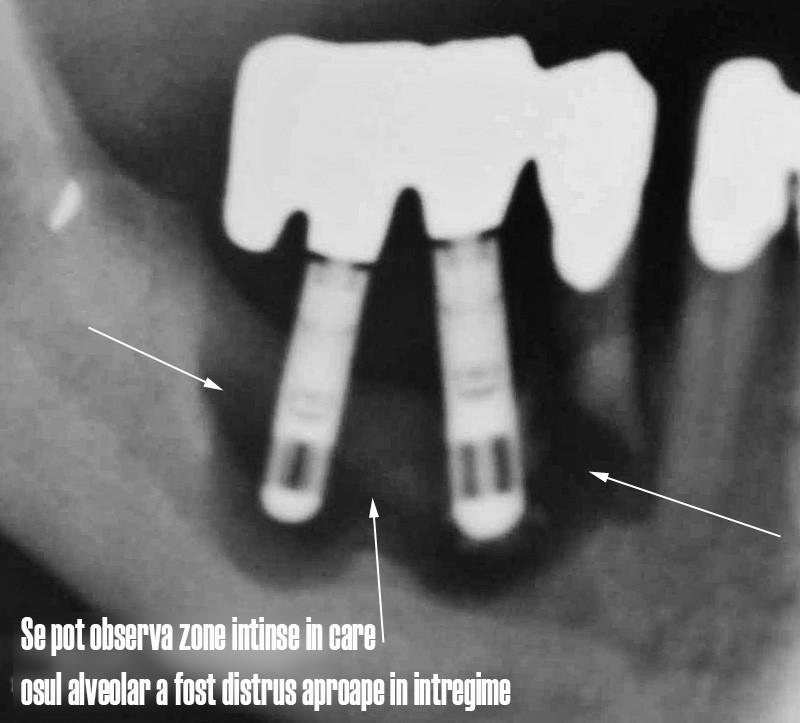 Tratament periimplantita