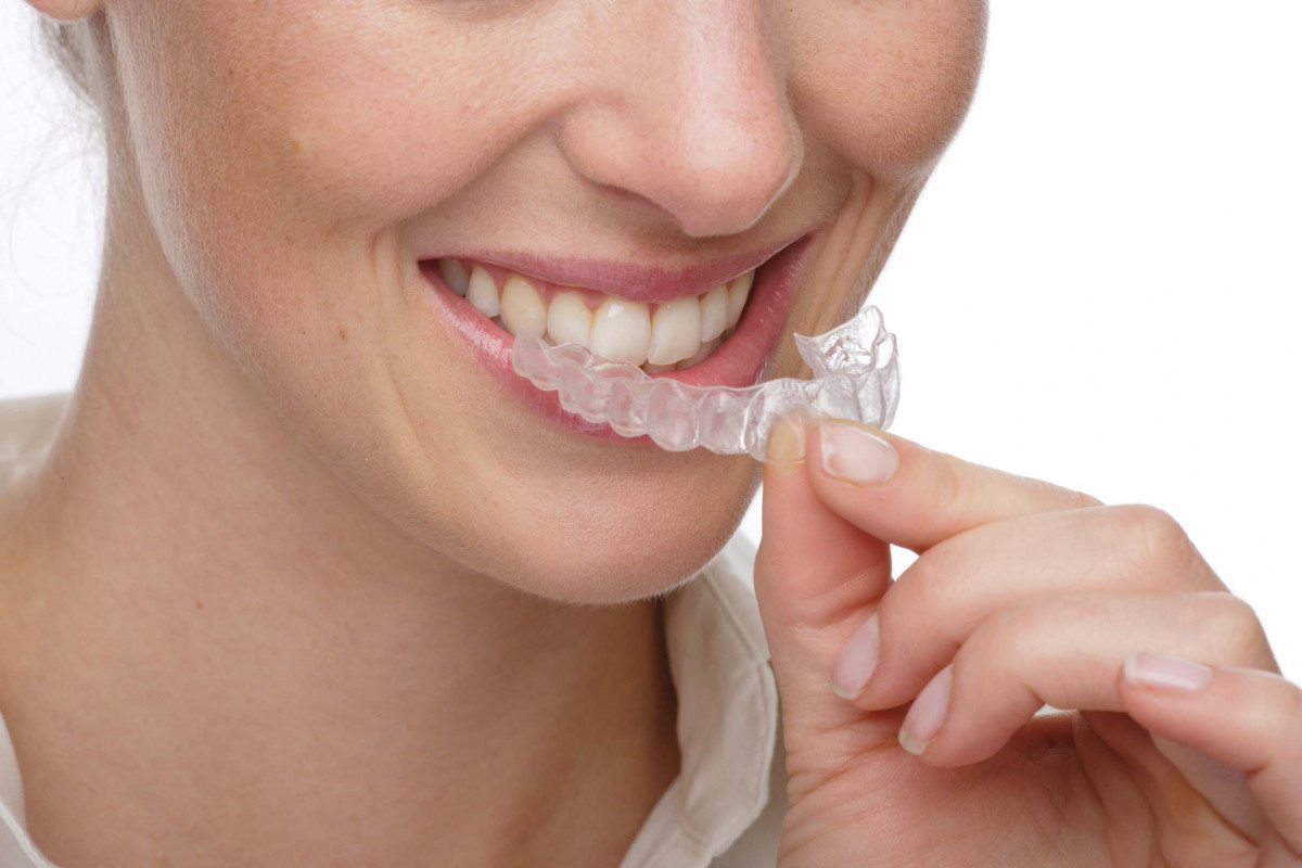 Alternativa aparatelor dentare fixe si mobile - Invisalign