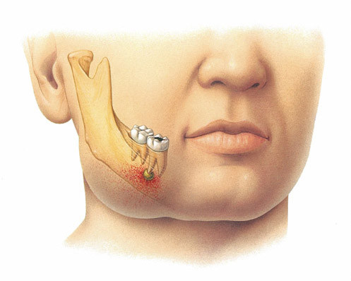 Infectia de focar dentara