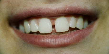 Diastema