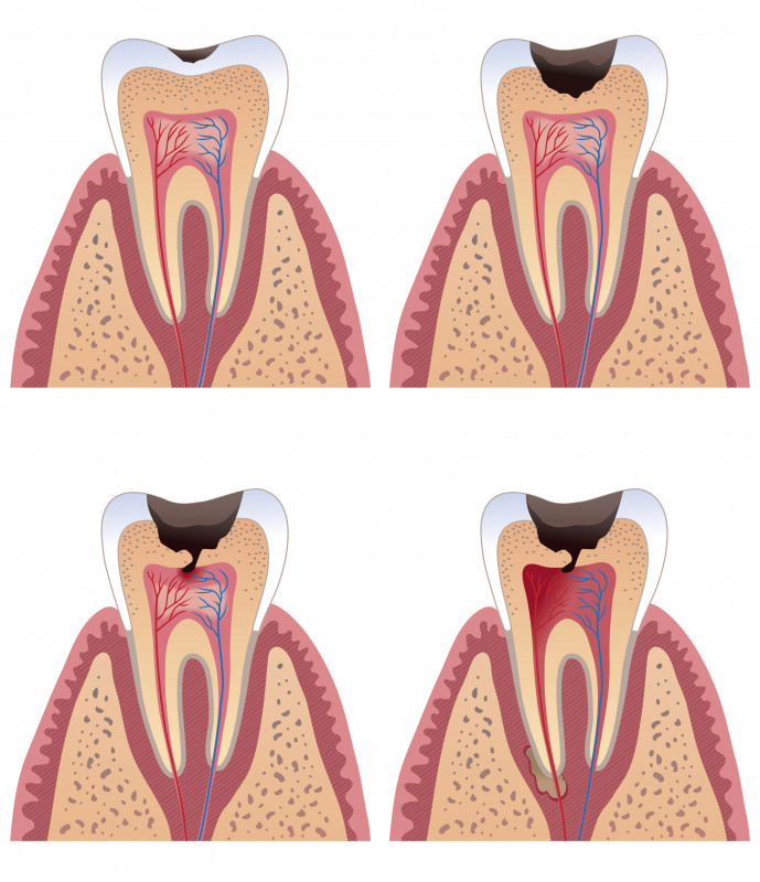 Mit sau adevăr despre caria dentară