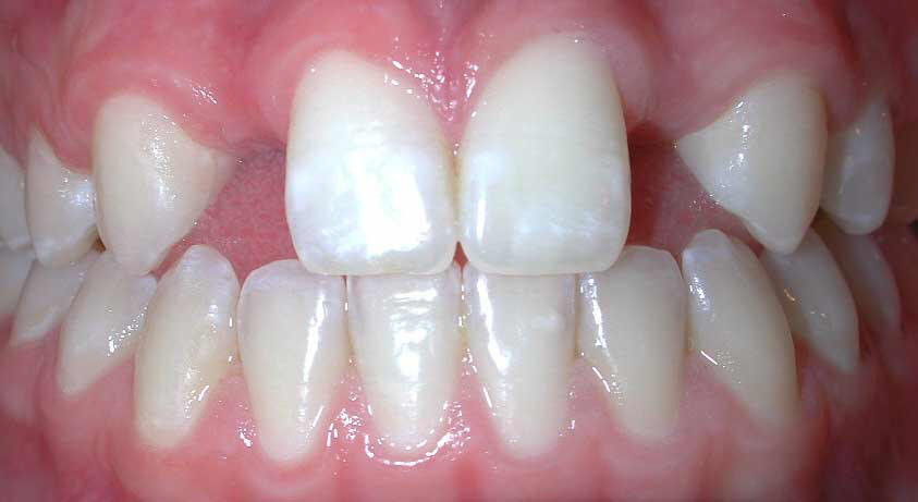 Anomalii dentare de numar
