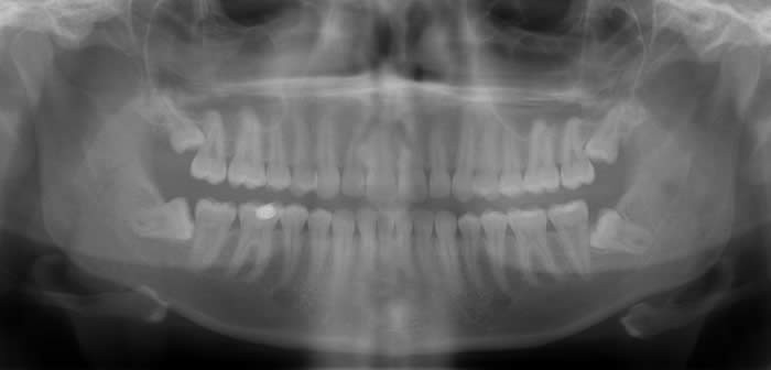 Radiografia panoramica