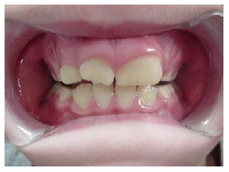 Amomalii dentare de volum