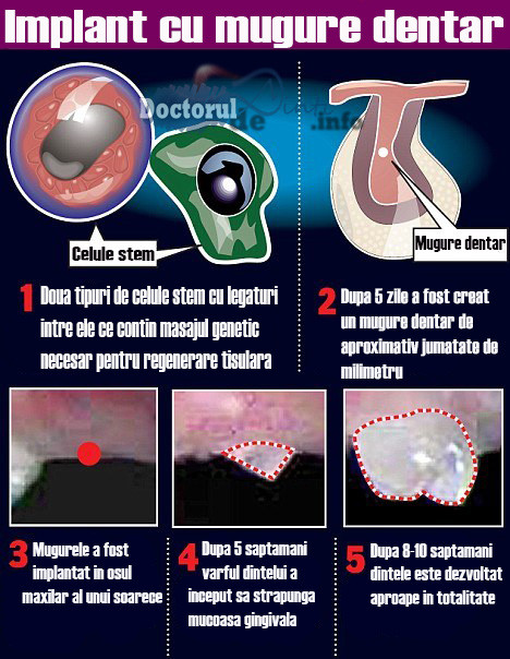 Implant cu mugure dentar - viitorul stomatologiei ?