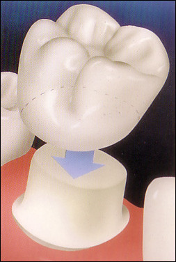 Coroana ceramică pe suport de metal vs. de zirconiu