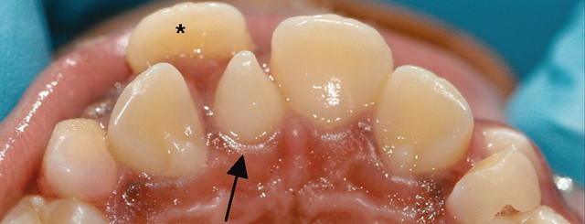 Modificarile unidentare de pozitie