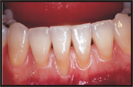 Retracţia gingivală