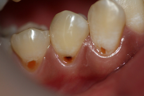 Eroziunea dentară
