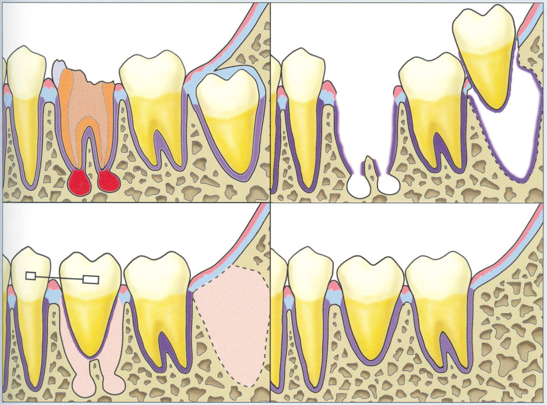 Transplantul dentar
