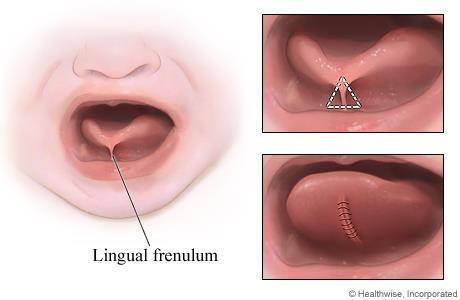 Anchiloglosia – “limba scurtă”