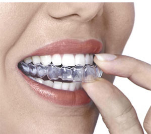 Gutiera pentru bruxism