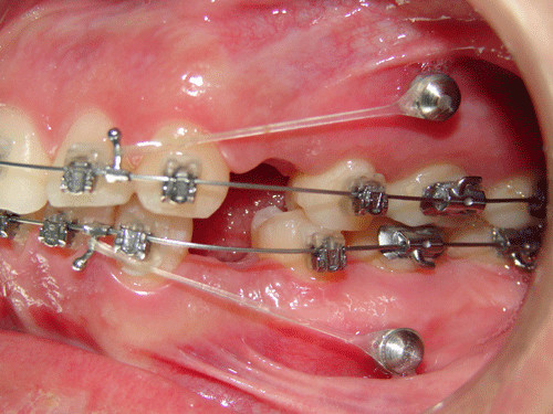 Mini-implantul dentar