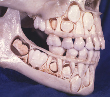 Fluoroza dentară