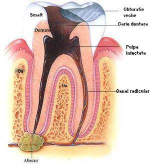 Complicatiile gangrenei pulpare