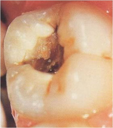 Caria dentara