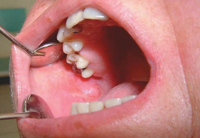 Diagnostic boli mucoasa orala