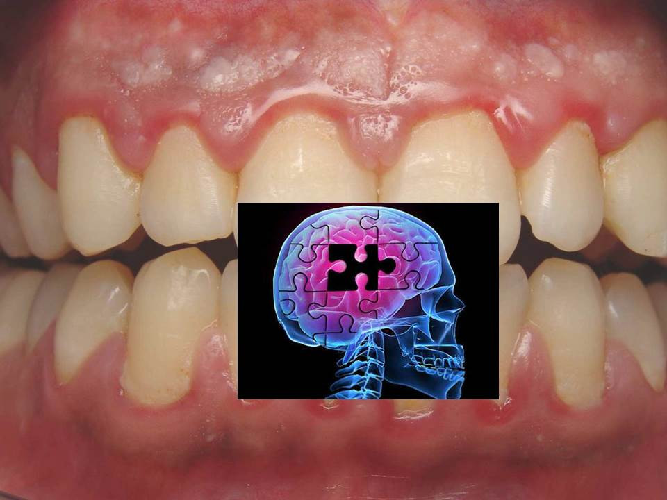 Alzheimerul si gingivita