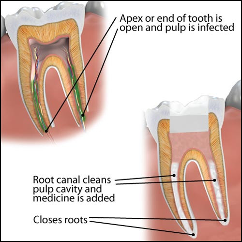 Apexificarea