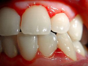 Tratamentul problemelor gingivale – remedii casnice